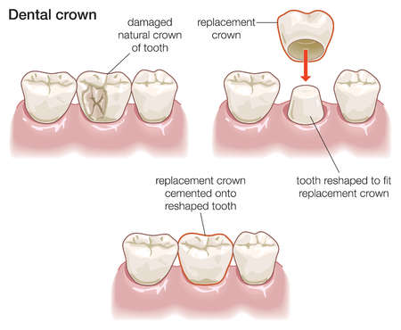 dental crowns Image