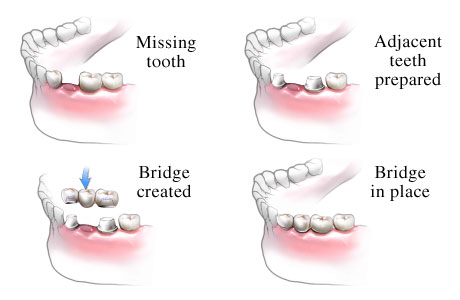 dental bridge Image