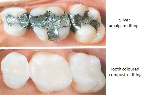 dental fillings Image