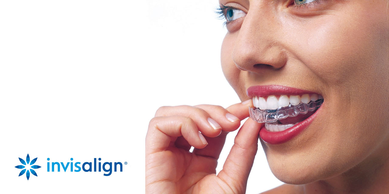 invisalign-aligners Image