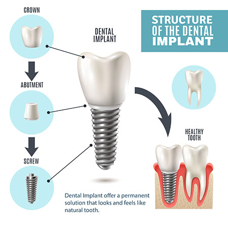 Dental Implants Explained