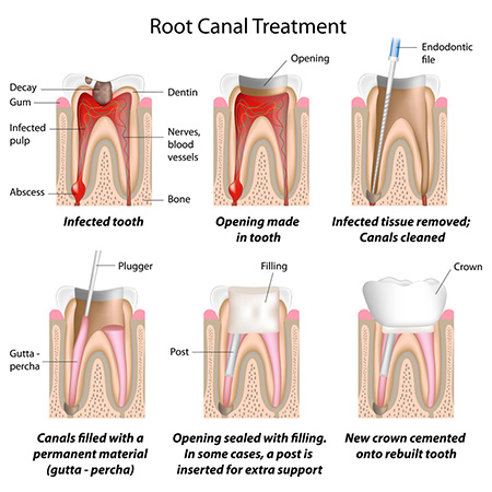 root-canal Image