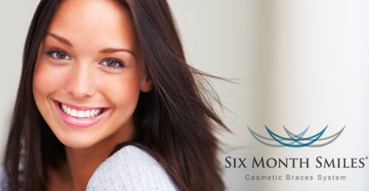 six-month-smiles-cosmetic-braces Image