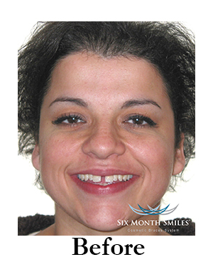 six-month-smiles-cosmetic-braces Image four before