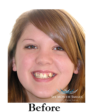 six-month-smiles-cosmetic-braces Image three before